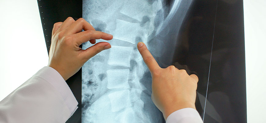 Patient with a slipped disc in need of spinal decompression therapy at Advanced Physical Medicine & Rehab in Miami